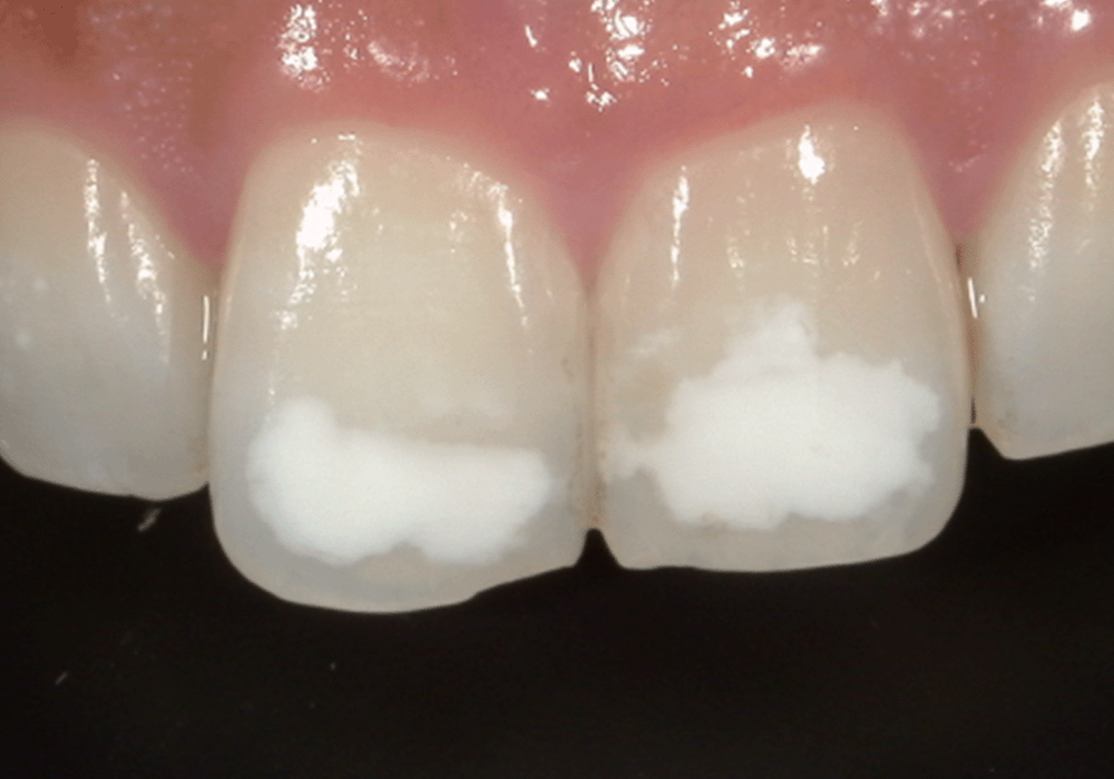 ホワイトスポット