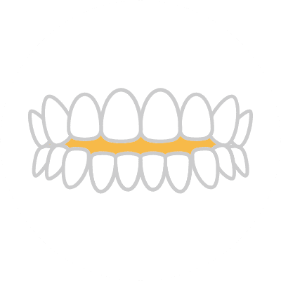 前歯が閉じない（開咬）