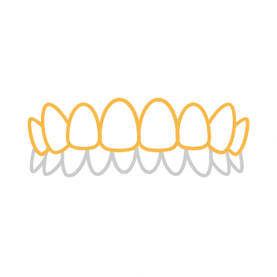 噛み合わせが深い（過蓋咬合）