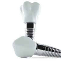 インプラントイメージ