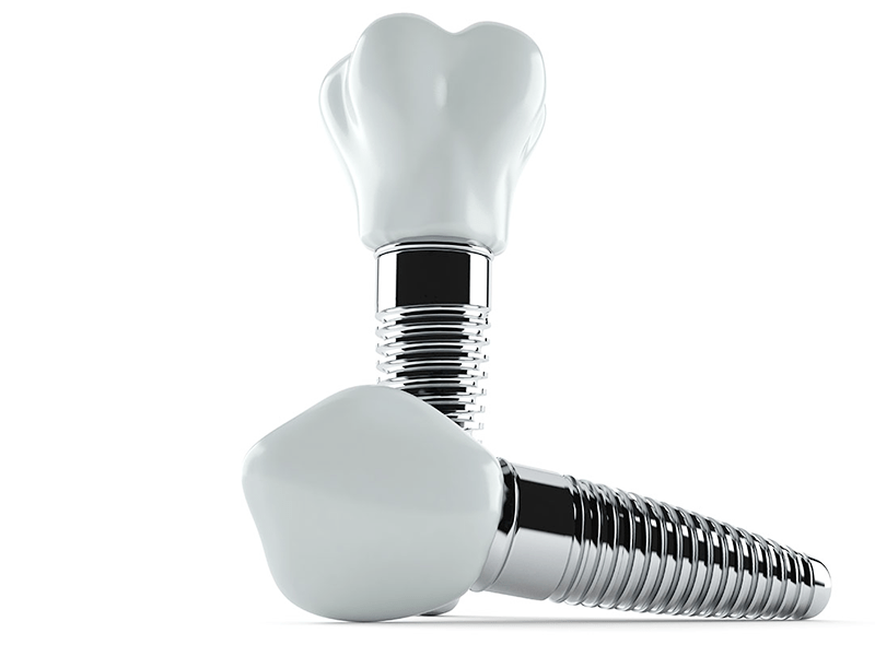 インプラントイメージ