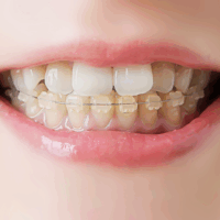 矯正治療について