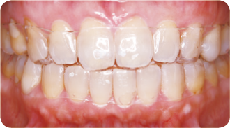 透明だから目立ちにくい